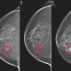 تشخیص 0 تا 100 توده با ماموگرافی