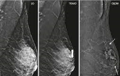 تشخیص توده با ماموگرافی