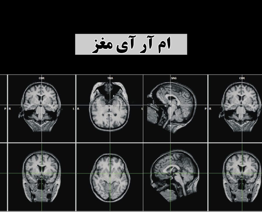 ام آر آی مغز