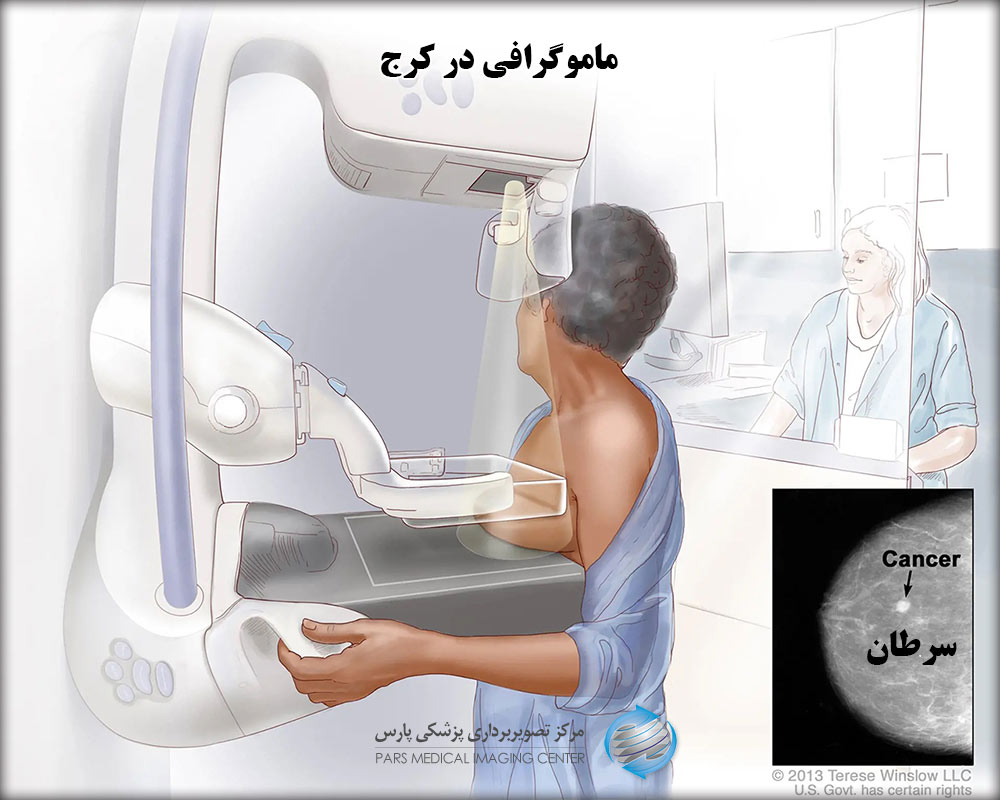 ماموگرافی کرج