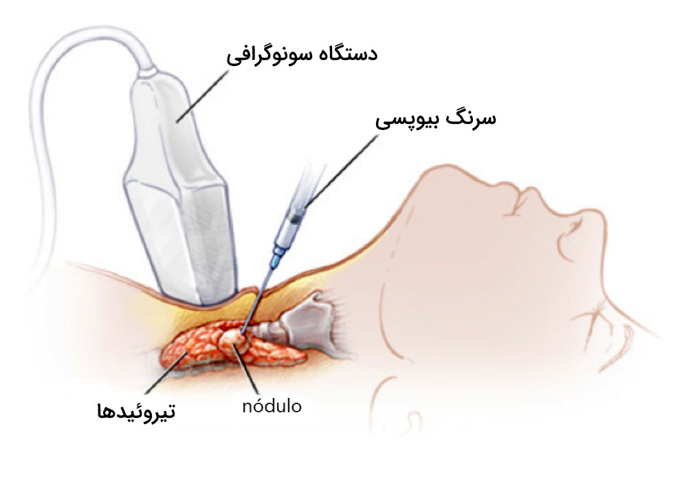نمونه برداری تیروئید