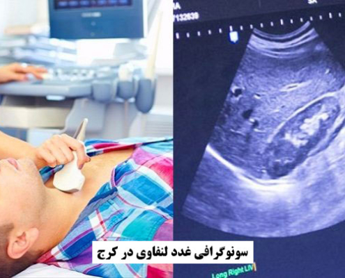 سونوگرافی غدد لنفاوی در کرج