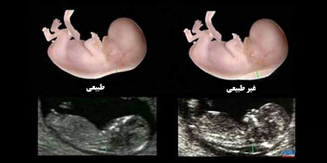 سونوگرافی غربالگری