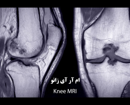 ام آر آی زانو