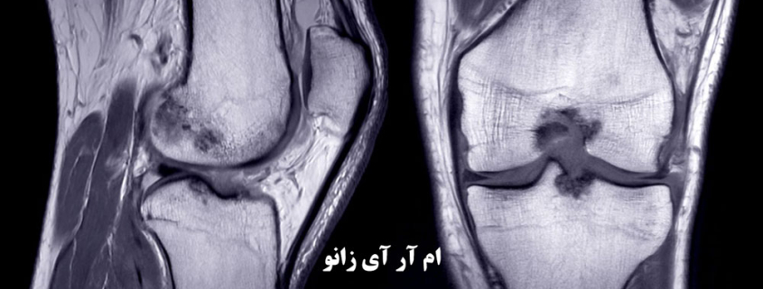 ام آر آی زانو