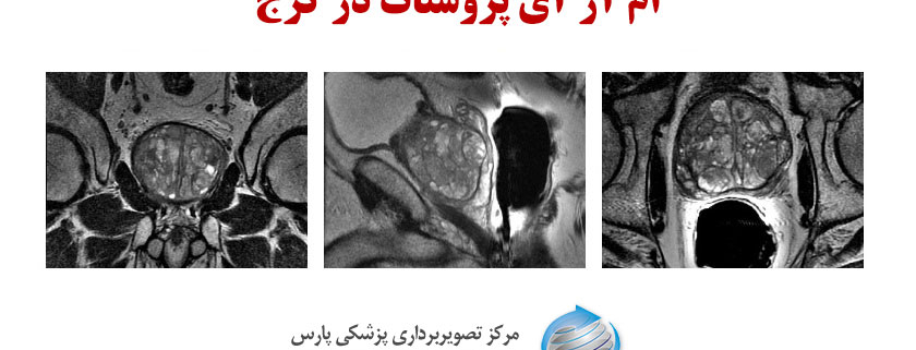 ام آر آی پروستات در کرج