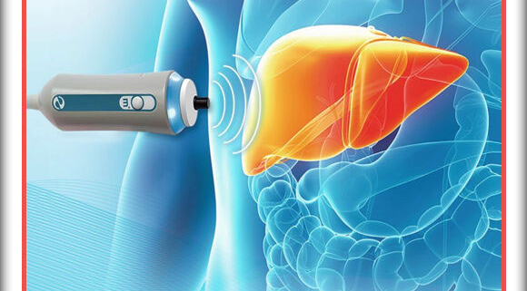 فیبرواسکن کبد در کرج