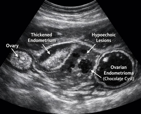 سونوگرافی آندومتریوز