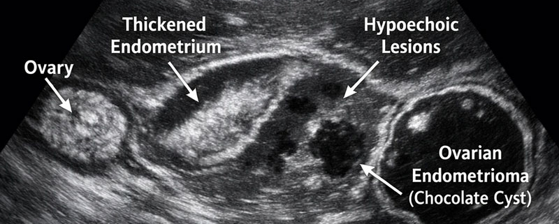سونوگرافی آندومتریوز