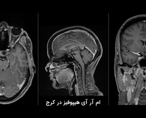 ام آر آی هیپوفیز در کرج