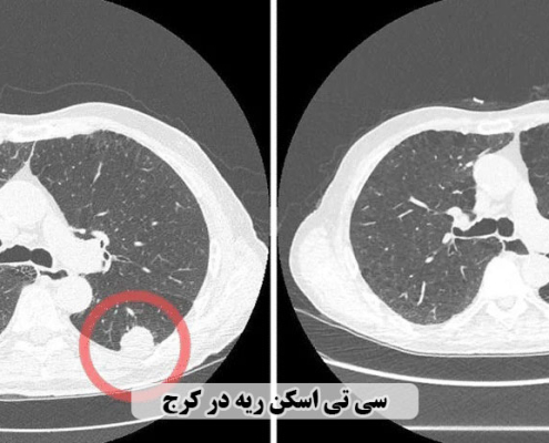 سی تی اسکن ریه در کرج