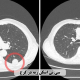 سی تی اسکن ریه در کرج