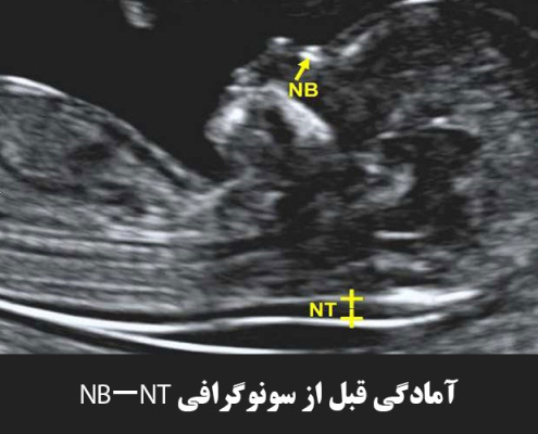 آمادگی قبل از سونوگرافی NB-NT