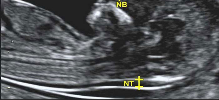 آمادگی قبل از سونوگرافی NB-NT