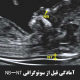 آمادگی قبل از سونوگرافی NB-NT