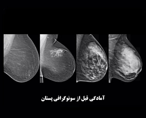 آمادگی قبل از سونوگرافی پستان