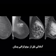 آمادگی قبل از سونوگرافی پستان