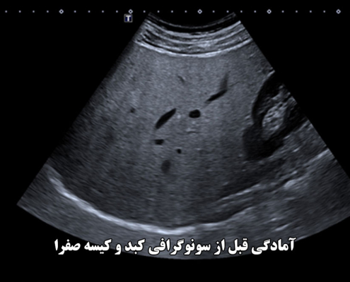 آمادگی قبل از سونوگرافی کبد و کیسه صفرا